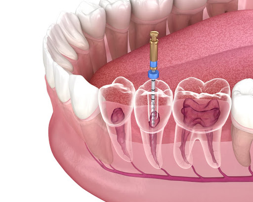 root canal therapy in fresno, ca